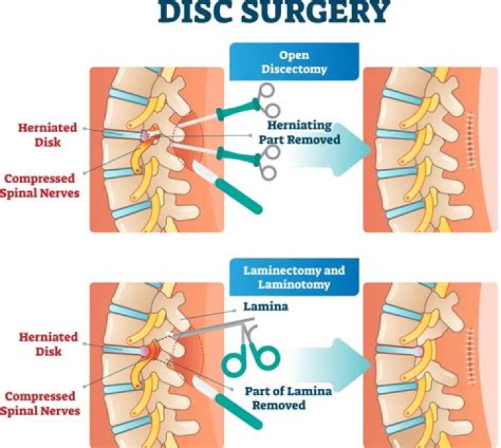 What is spinal surgery called