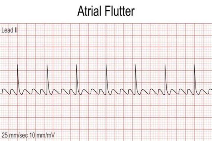What is the drug of choice for atrial flutter