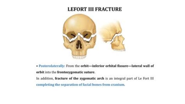 What is the Lefort fracture