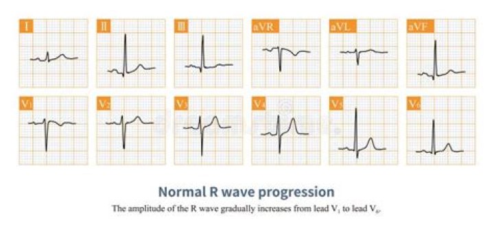 What is the normal R wave progression in leads v1 v6