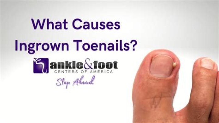 What kills ingrown toenail
