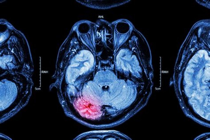 What scan shows brain death