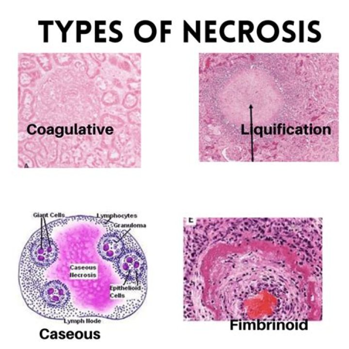 What type of necrosis is associated with pulmonary tuberculosis