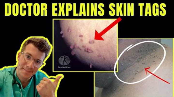 What virus causes skin tags