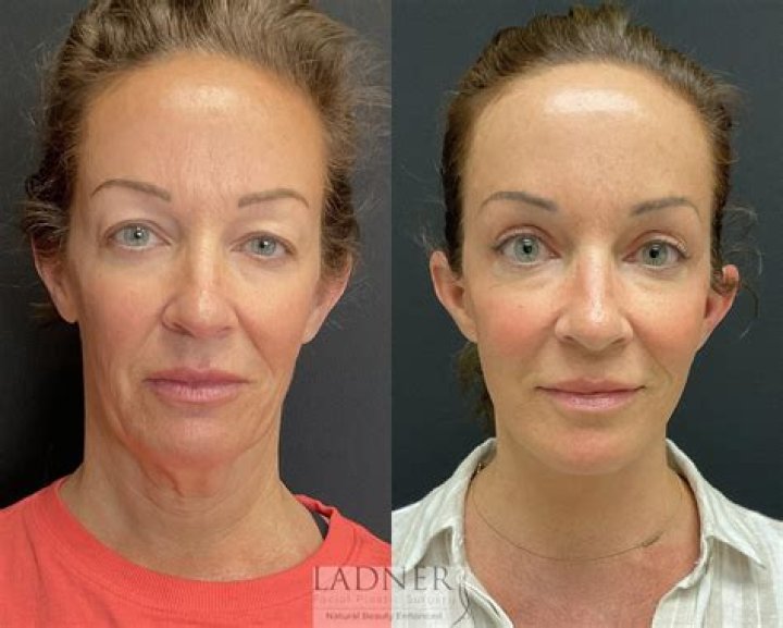 Whats a deep plane facelift