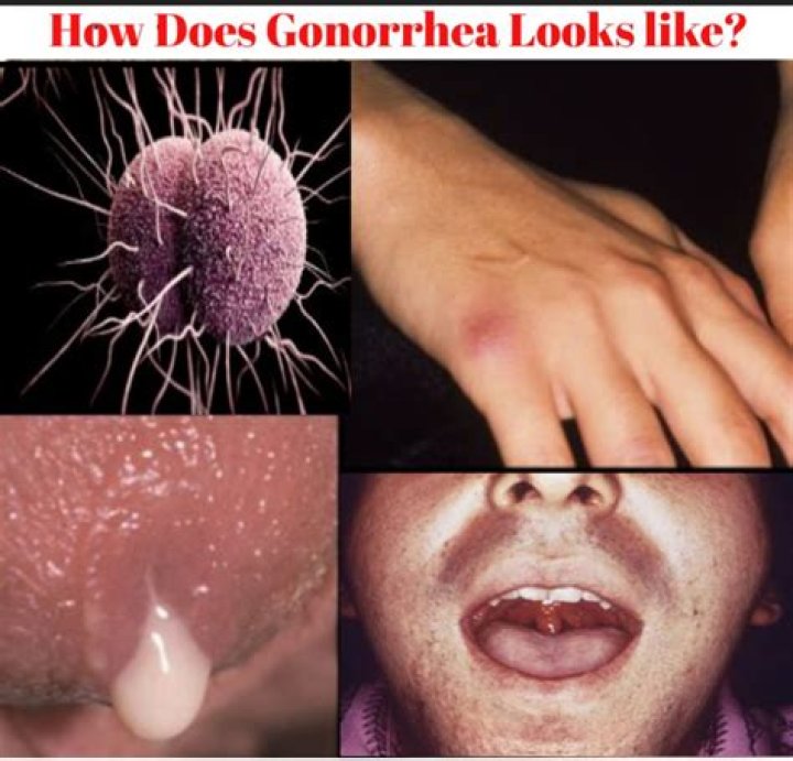 Whats gonorrhea look like