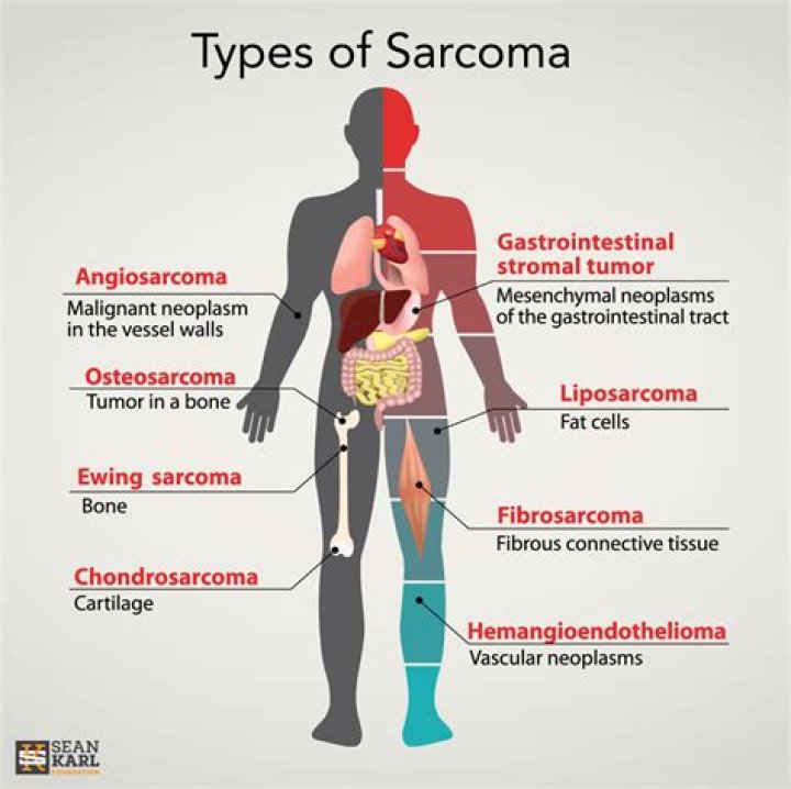 Where do sarcomas originate