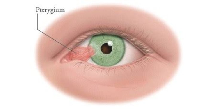 Where does pterygium occur