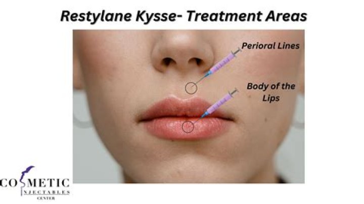 Where is Restylane injected