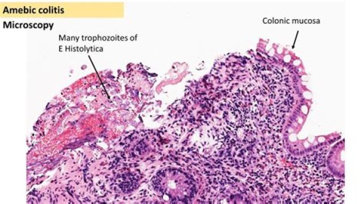 Which disease is caused by Entamoeba histolytica