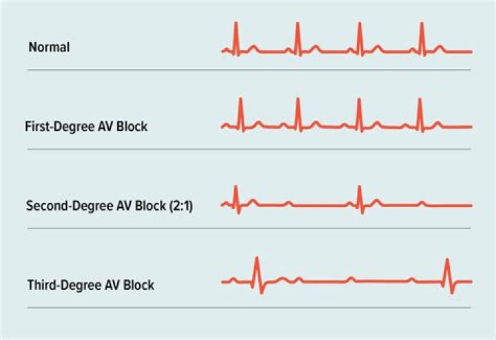 Which drug should be avoided in patients with second degree heart block