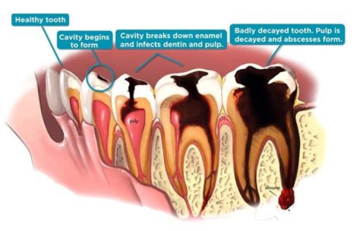 Which is used to remove decayed dentin from a cavity