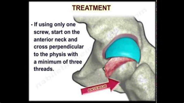 Which pain characteristic is associated with an unstable slipped capital femoral epiphysis
