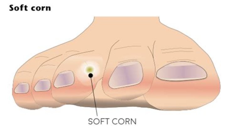 Why are soft corns painful