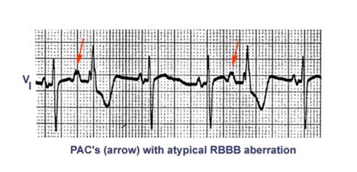 Why do aberrant PACS occur