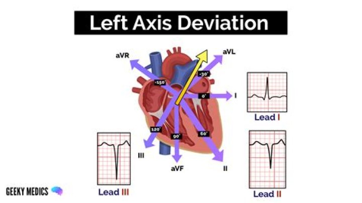 Why does left anterior Hemiblock cause left axis deviation