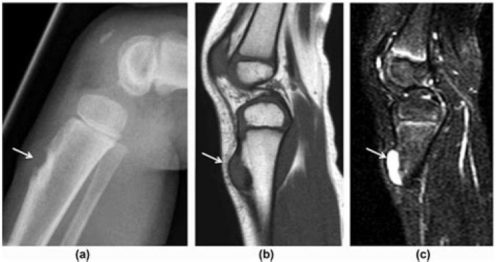Why does my tibial tuberosity hurt