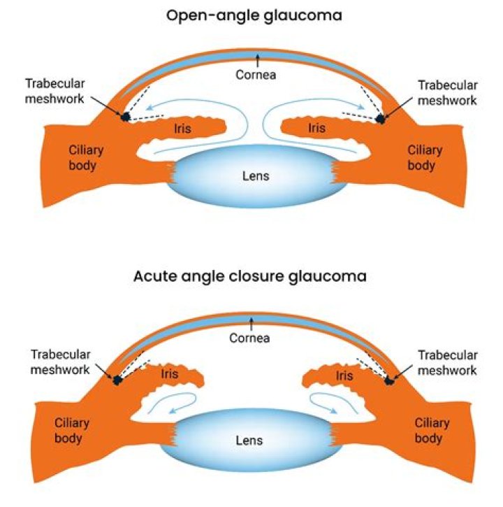 Why is epinephrine contraindicated in closed angle glaucoma