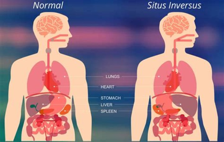 Why is situs inversus rare